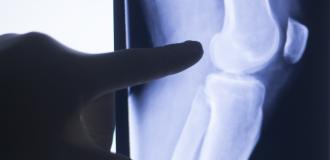 Why are so many Orthopaedic Fractures missed?